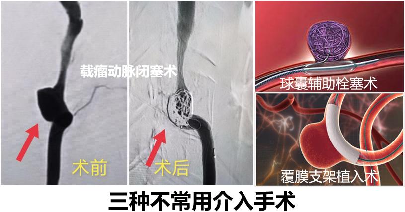 颅内动脉瘤介入栓塞最好的医院,颅内动脉瘤介入栓塞术后并发症