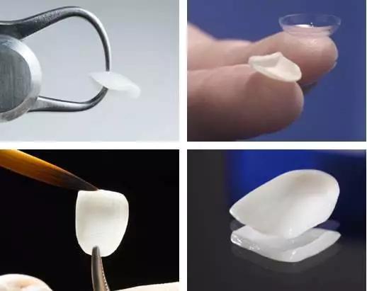 Helen齿科中心——全瓷贴面让你明眸皓齿不是梦