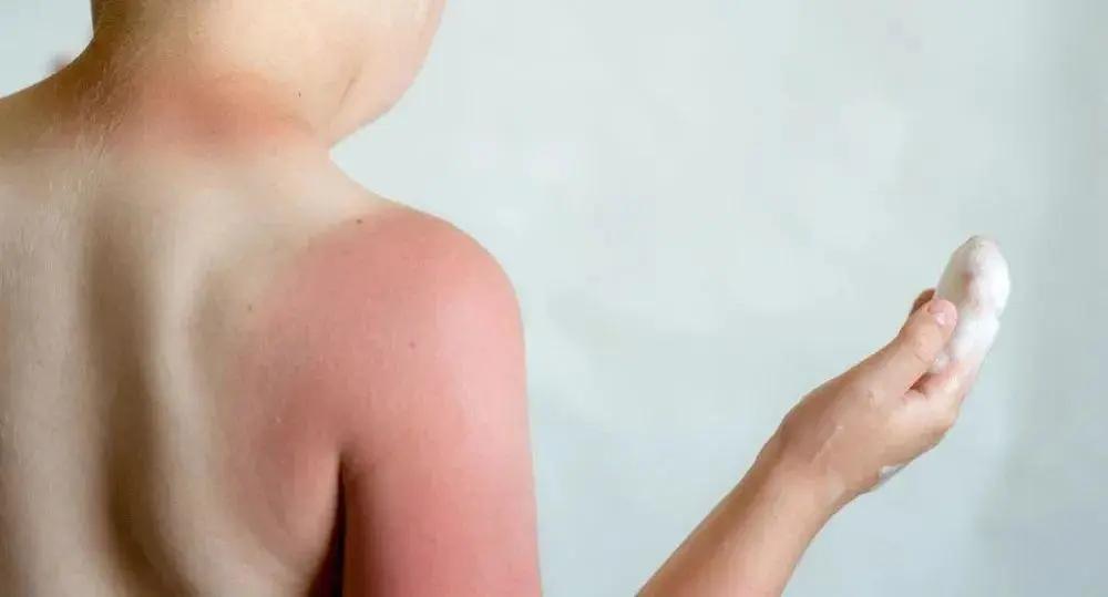 儿童防晒晒黑,婴儿被太阳晒伤皮肤发红急救方法