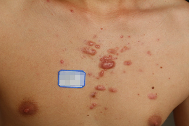 胸前疤痕疙瘩祛疤手术一般多少钱,疤痕疙瘩胸前激光去除需要多少钱