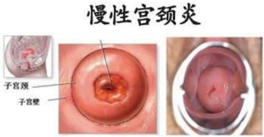 肚子不舒服，下腹坠胀，会不会是宫颈炎？