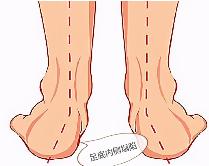 小腿外侧粗改善动作,小腿外扩和小腿外翻用什么矫正