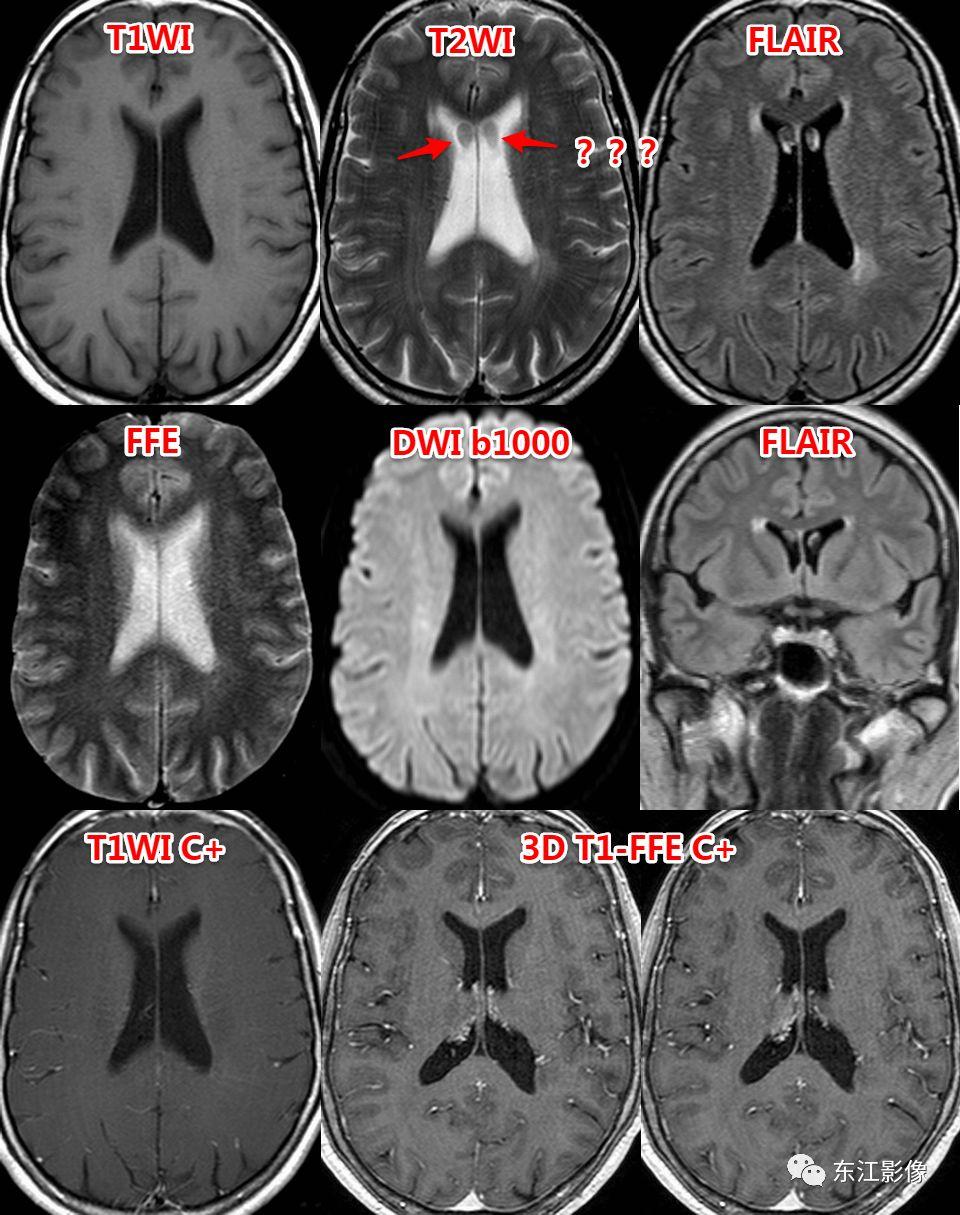 头颅mri扫描影像哪里找,头颅影像mra详细解说