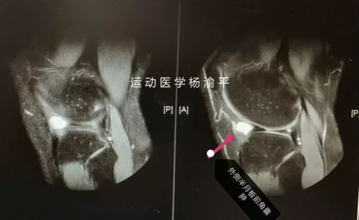 半月板缝合可以真正的愈合么,半月板缝合手术三年了膝盖还是痛