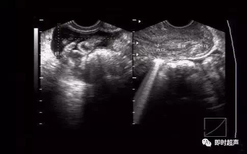 妇科阴式超声检查方法,盆底超声可检查什么疾病