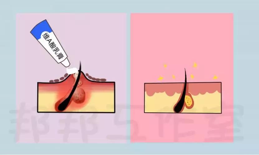 白头黑头粉刺怎么消除,长黑头粉刺的正确消除方法