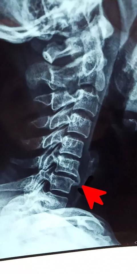 颈椎腰腿痛治疗手法,老中医治疗颈椎腰腿疼