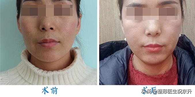 法令纹不做医美可以去除吗,祛除法令纹做什么手术效果好