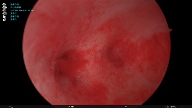 医联体再结硕果,南大一附院井冈山医院妇产科腔镜技术实现全面突破
