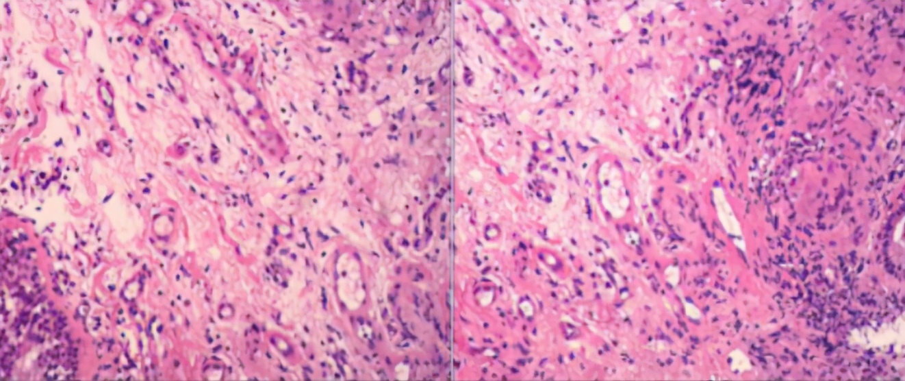 鍖荤敓鏃犳硶鍒ゆ柇缁撹妭鐥呰繕鏄粨鏍哥梾,鏈夎偤缁撴牳鐥呭彶鍗佸嚑骞存煡鍑鸿偤缁撹妭