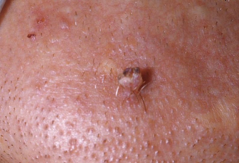 感染hpv有什么明显的症状,感染hpv有什么明显的感觉吗