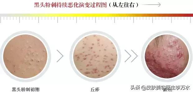 痘痘十大真相,痘痘大全图解