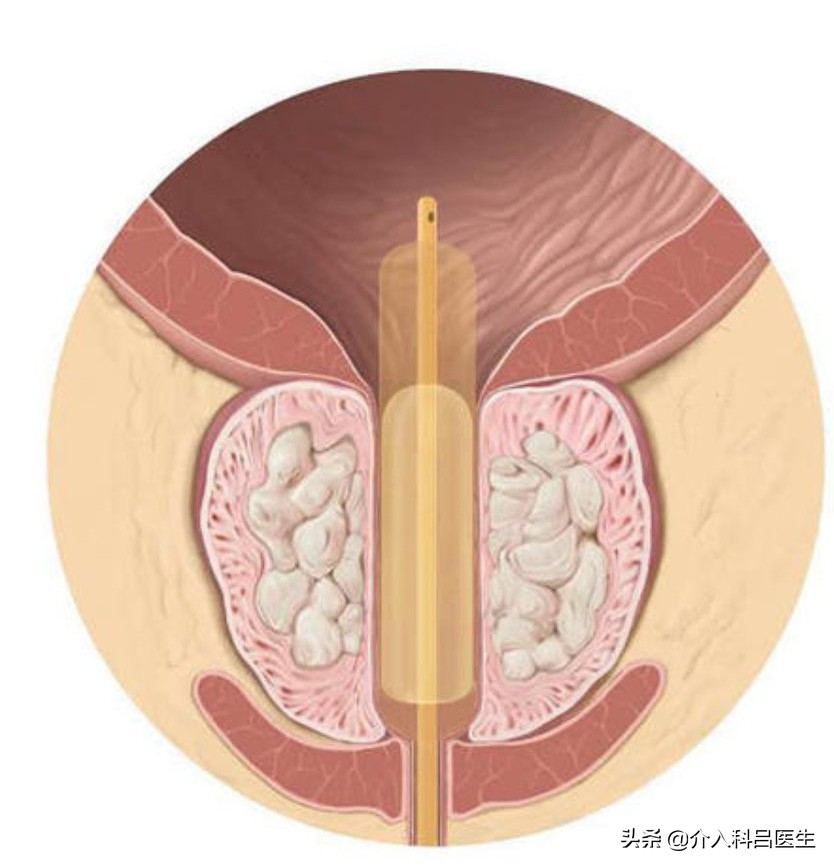 前列腺增生尿频夜尿多吃中成药,前列腺增生尿频尿急漏尿如何治疗