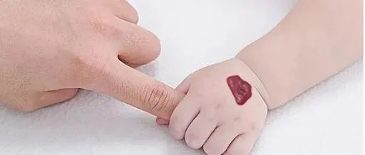 新生儿红胎记与血管瘤区别,红胎记血管瘤的最佳消除方法