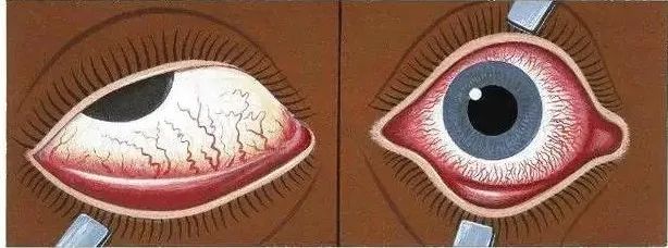 视力模糊揉一揉又清晰,左眼视物模糊揉一揉就好了