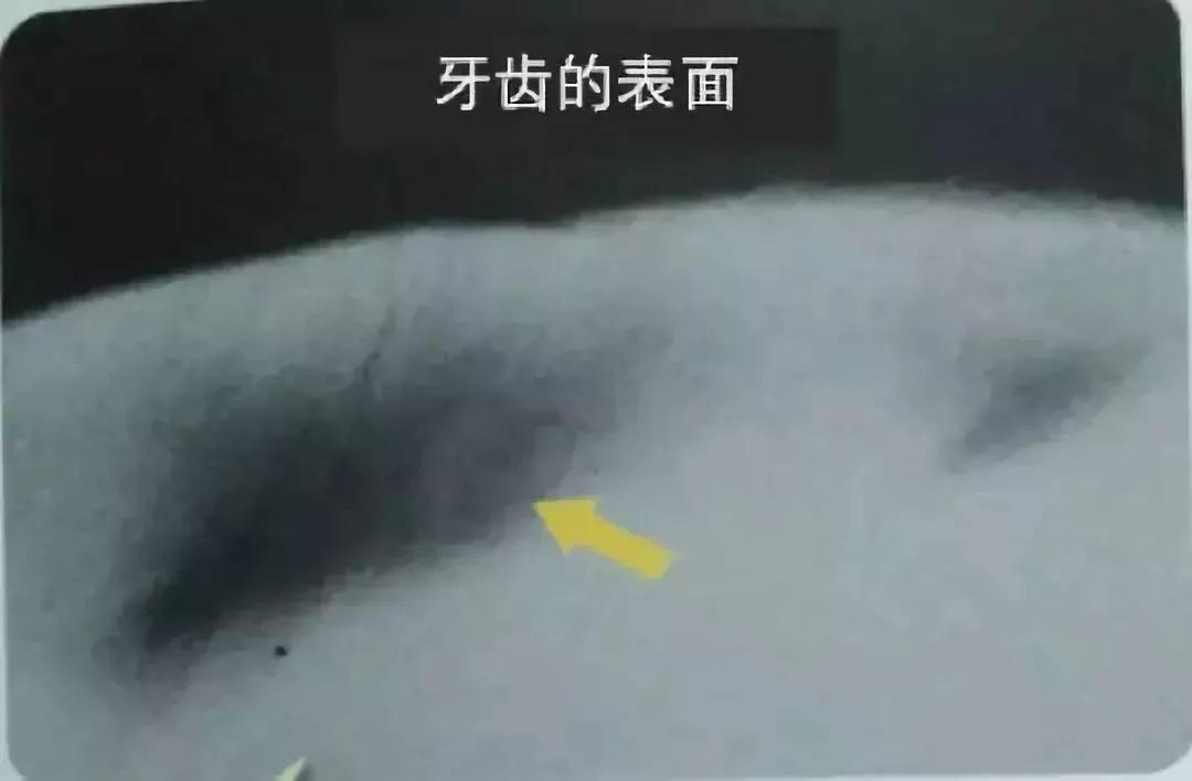 牙齿有白色斑点怎么办,孩子牙齿出现白色怎么回事