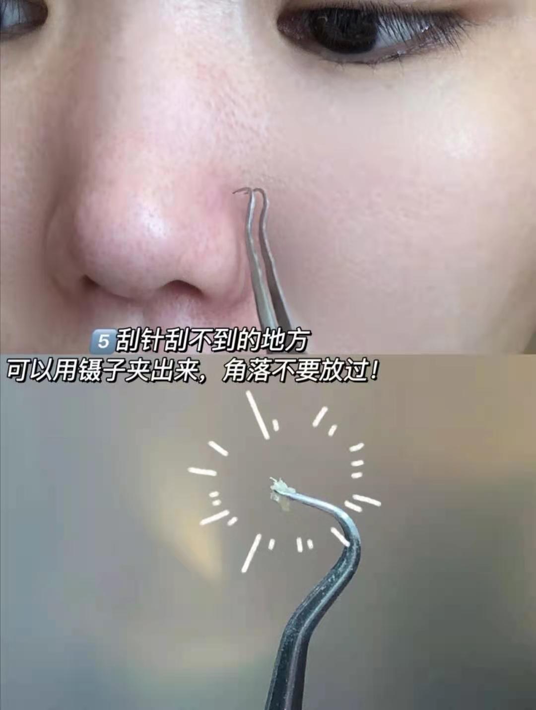 去黑头收缩毛孔的最好方法甲硝唑,男士去黑头收缩毛孔洗面奶