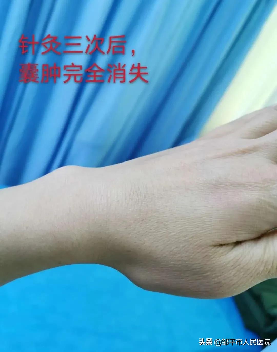 针灸三次就有效果还需要再扎吗,针灸治疗皮下囊肿