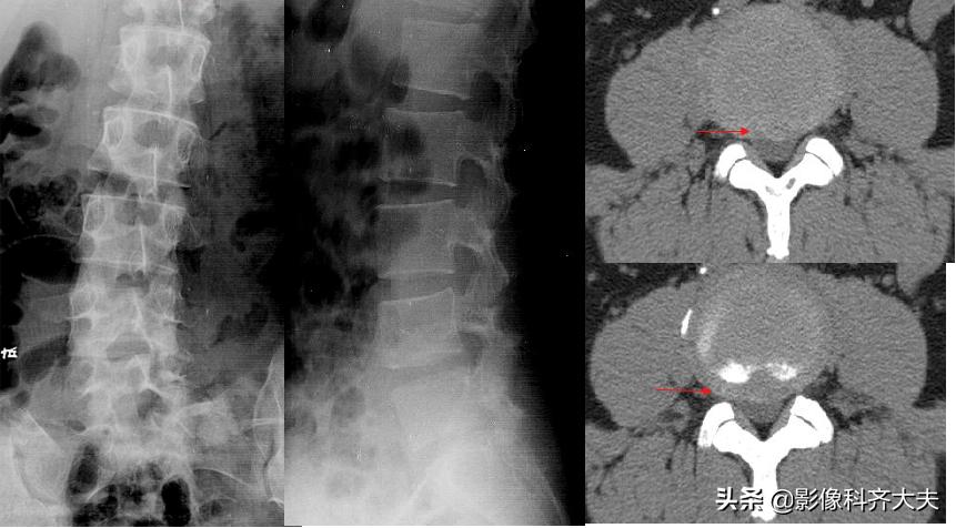 腰椎间盘突出的影像学诊断及治疗,腰椎间盘突出影像学课件