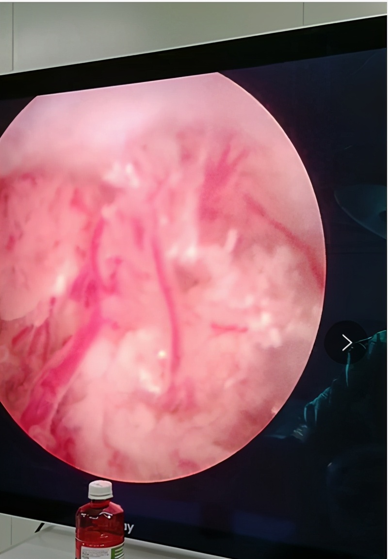 2岁女儿出血,2岁女童间断性出血