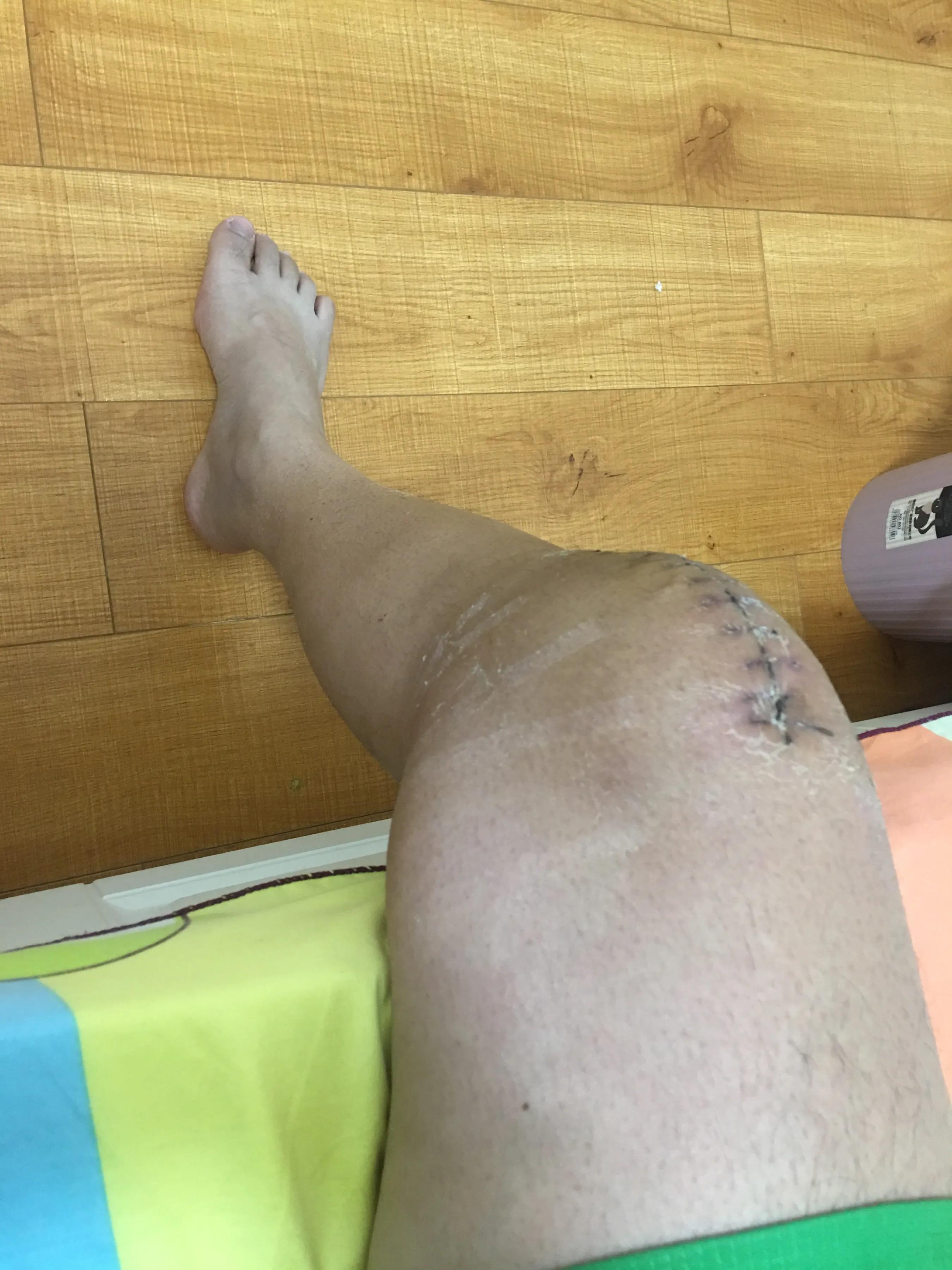 髌骨骨折取内固定费用多少,髌骨骨折保守治疗后的康复训练