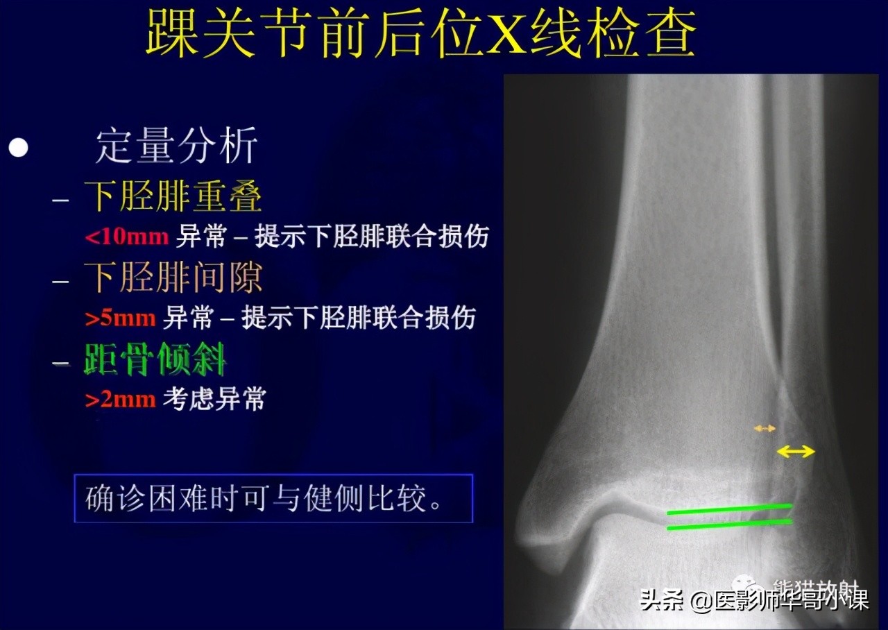 踝关节解剖视频课,解剖学韧带分布图