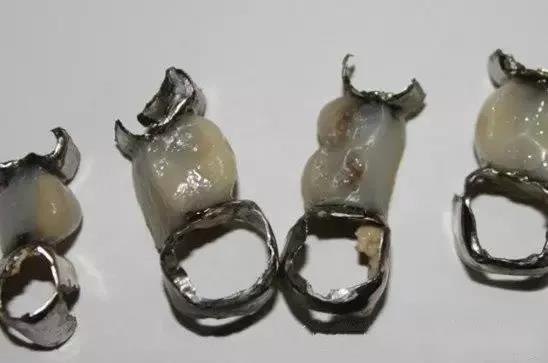 烤瓷牙做了人变丑了,烤瓷牙套里的牙烂了有什么症状