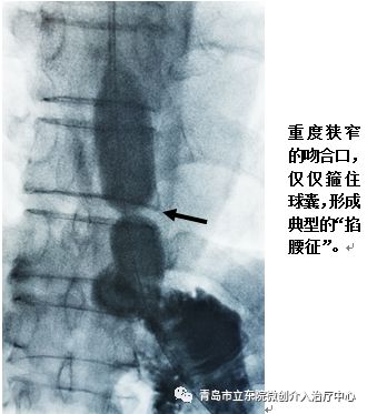 胃肠吻合术后不能经口进食,胃切除后食管空肠吻合口瘘怎么办