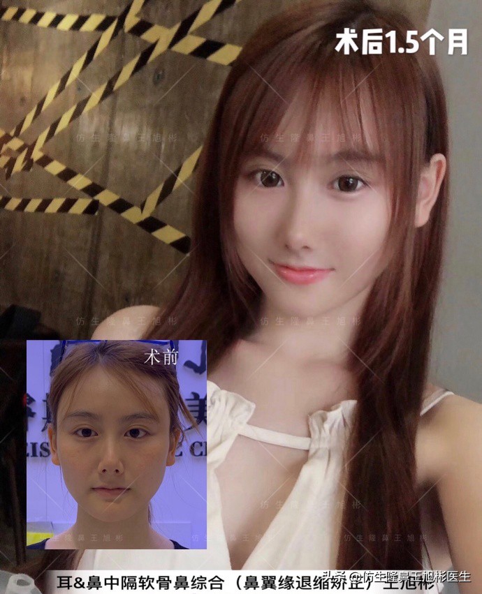 王旭彬：朝天鼻、露鼻孔，模特菲菲短鼻矫正手术后1.5个月