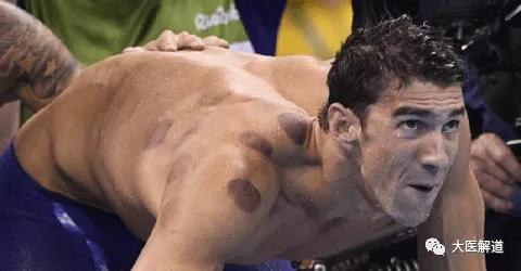 拔火罐利用了什么知识,拔火罐的技巧和手法视频