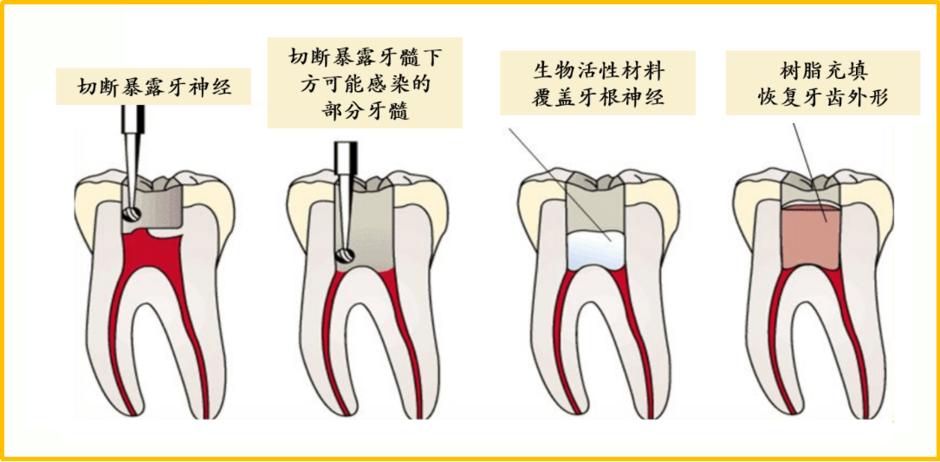 牙齿断了把牙根拔出,牙齿断了拿另一半能补吗