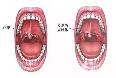 扁桃体发炎与扁桃体癌的区别,扁桃体瘤和扁桃体癌的区别