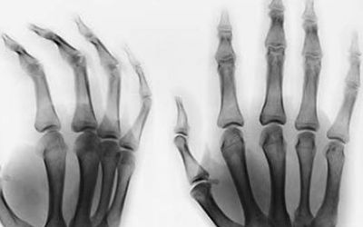 治疗类风湿最好的方法是,类风湿性关节炎症状和治疗方法