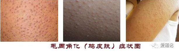 皮肤出现了很多小红点,皮肤上的小红点是怎么回事