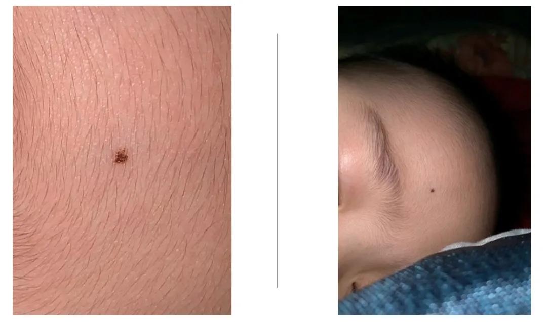 宝宝刚长出来的痣怎么消除,婴儿先天的痣容易癌变