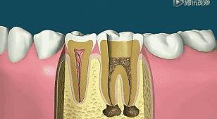 根管治疗后期症状,根管治疗全过程真的很痛吗