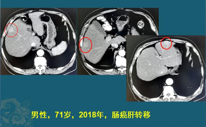 癌症转移到肺部就是肺癌了么,癌症患者转移到肝上多久才有症状