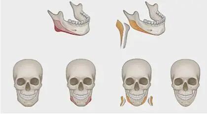 下颌角宽大怎么改善男生,怎样改善下颌变小