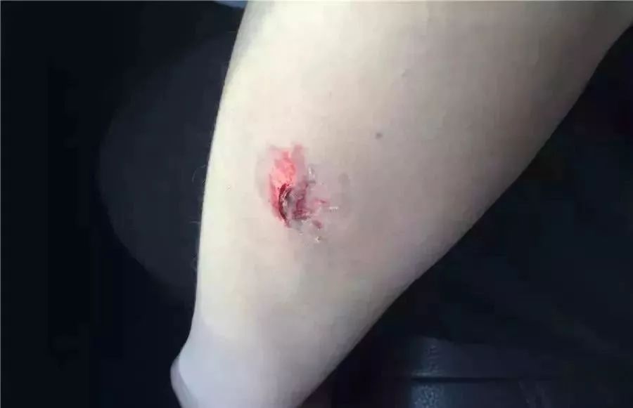 警察抓了吸毒的人要去医院吗,禁毒民警抓捕时疑感染艾滋