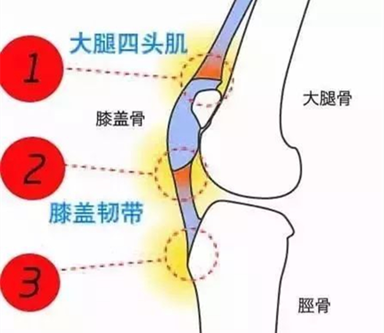 胫骨结节骨软骨病是怎么引起的,胫骨结节软骨炎不痛要治疗吗