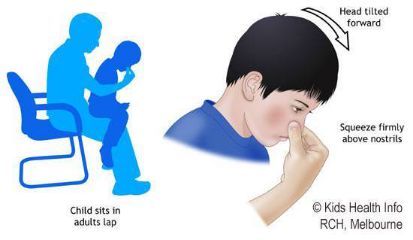 鼻出血护理应急演练,学生鼻出血应急演练视频制作