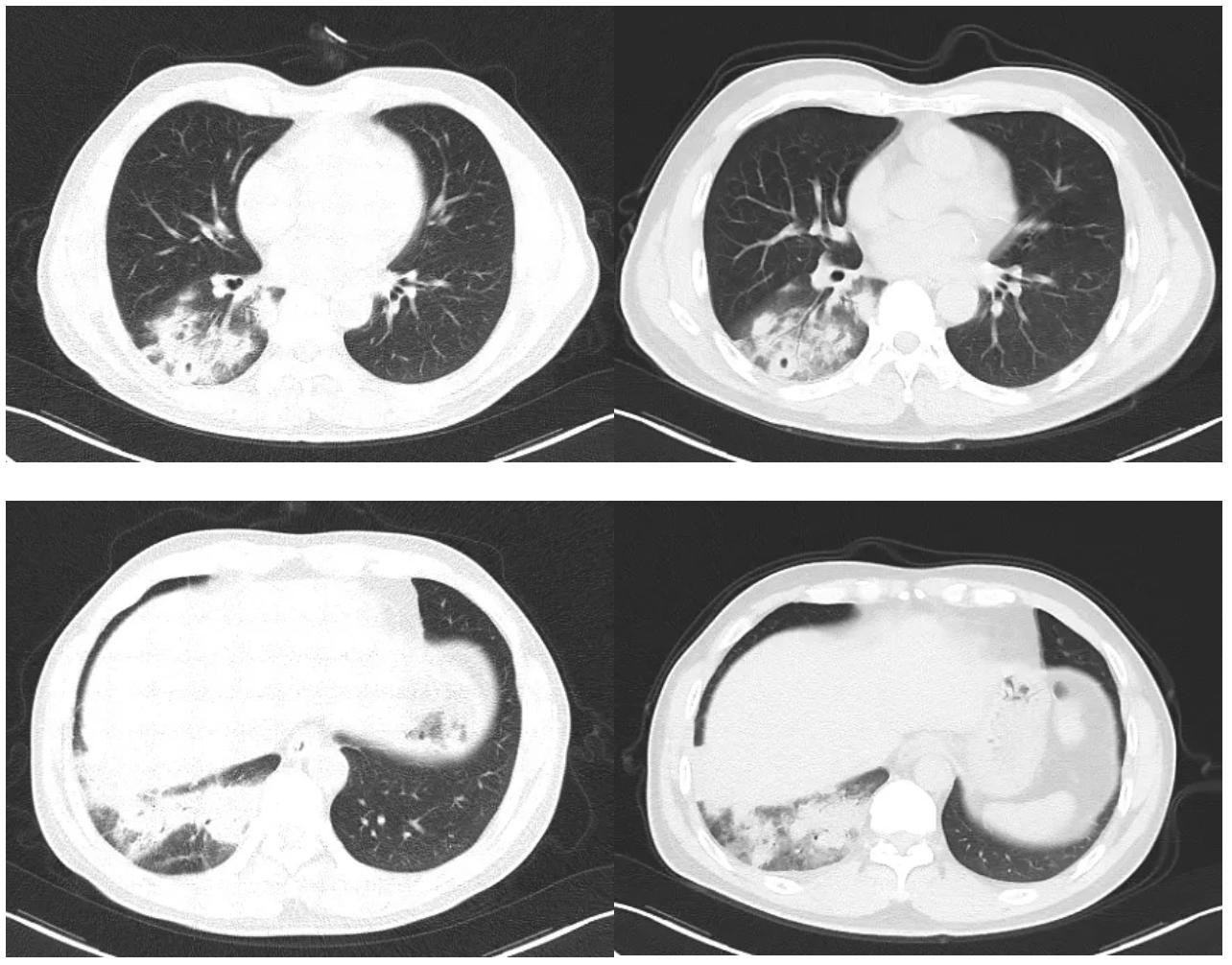 肺炎不干预治疗一般多久可以痊愈,肺炎治疗20天不见好转