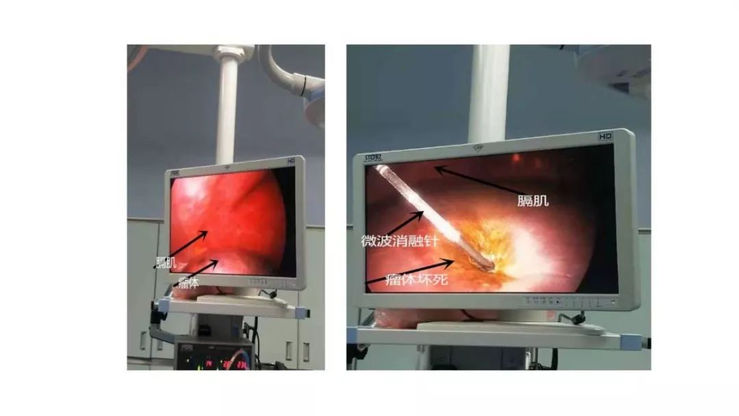 天津肝血管瘤射频消融术,肝血管瘤穿刺射频消融术