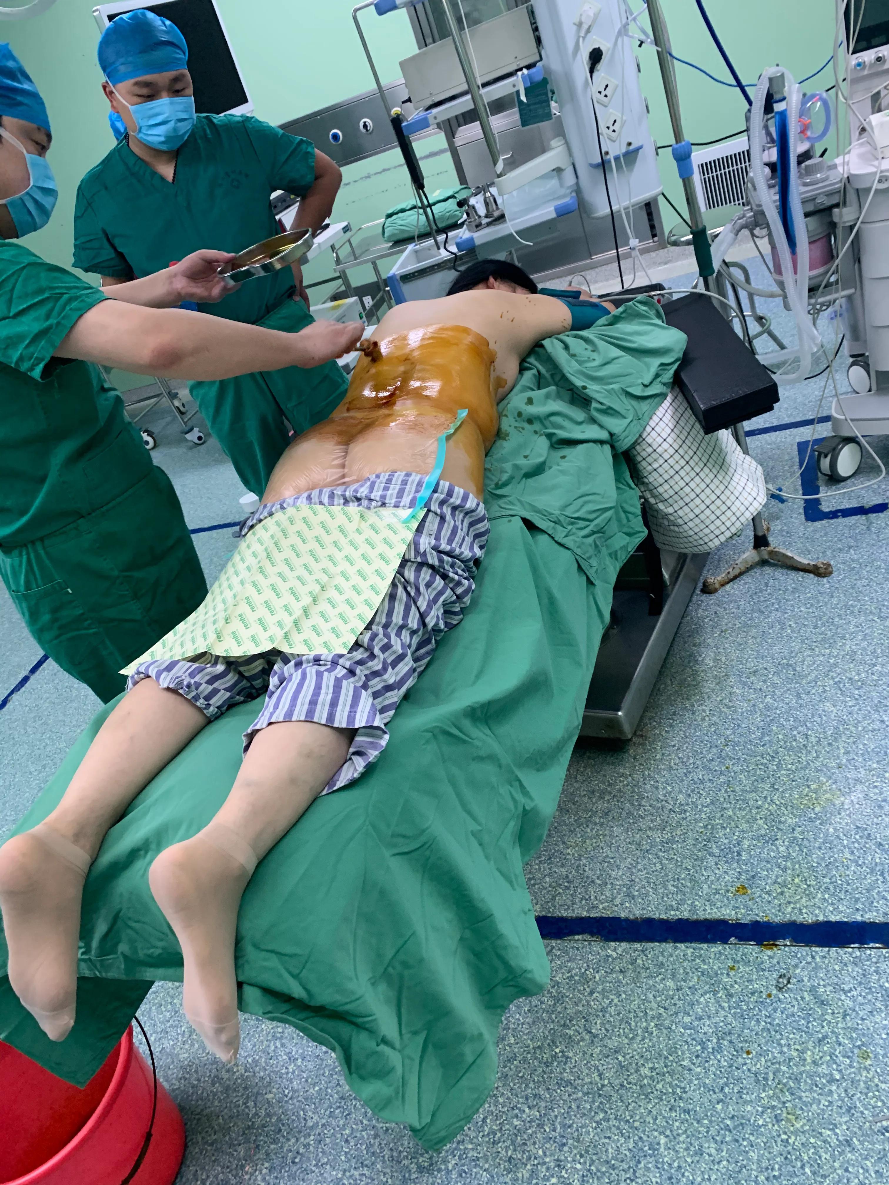 椎间孔镜术后腰痛症状多久消失,盘源性腰痛手术后易复发吗