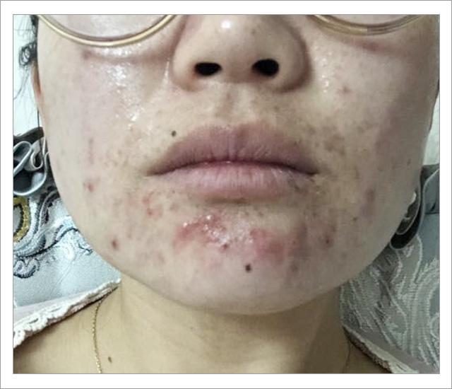 脸上螨虫的正确消灭方法,脸上的螨虫能不能彻底消灭