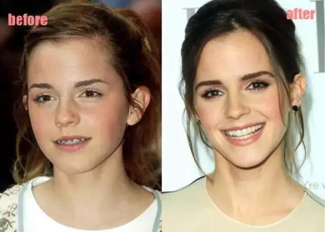 矫正牙齿可以改变小下颌吗,矫正牙齿可以改变脸型