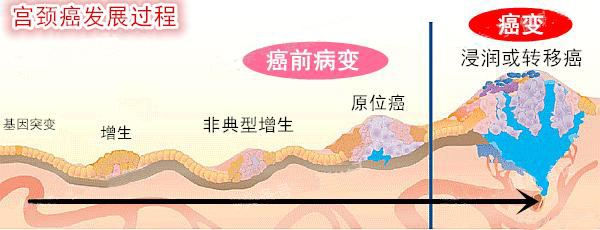 宫颈病怎么预防,妈妈得了宫颈癌子女该注意什么
