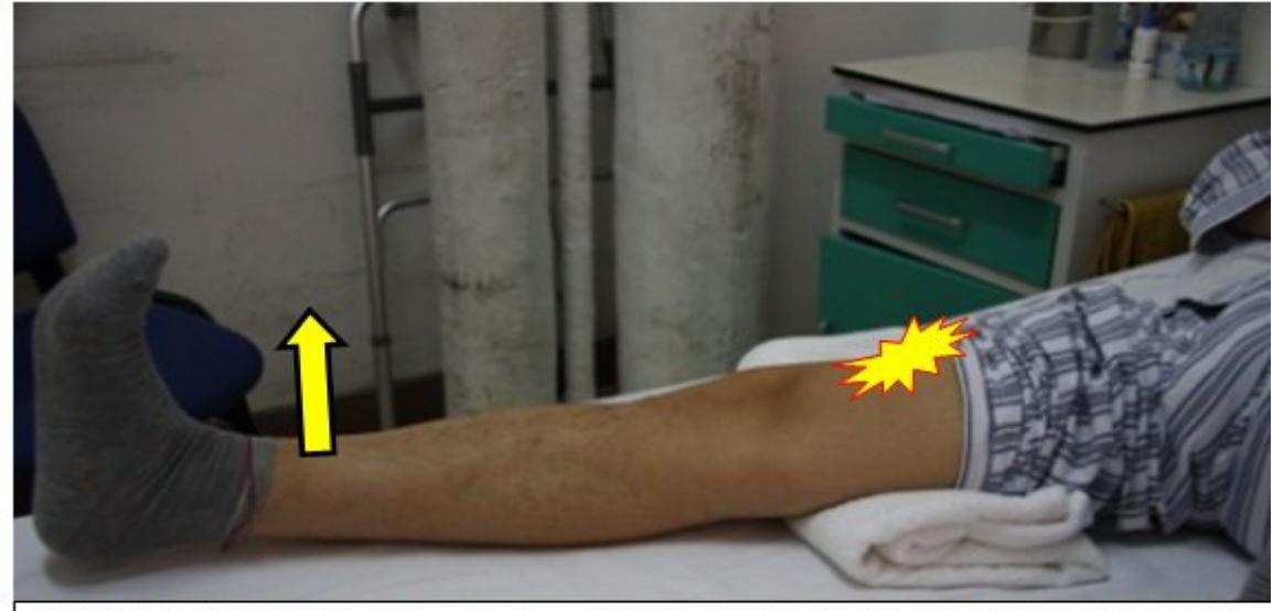 前叉术后不掰腿能不能恢复正常,前叉重建术后康复必须天天掰腿吗