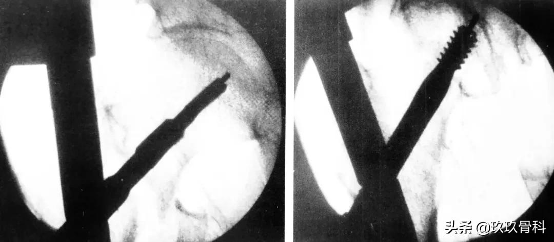 骨科用髓内钉什么材料,骨科髓内钉的作用