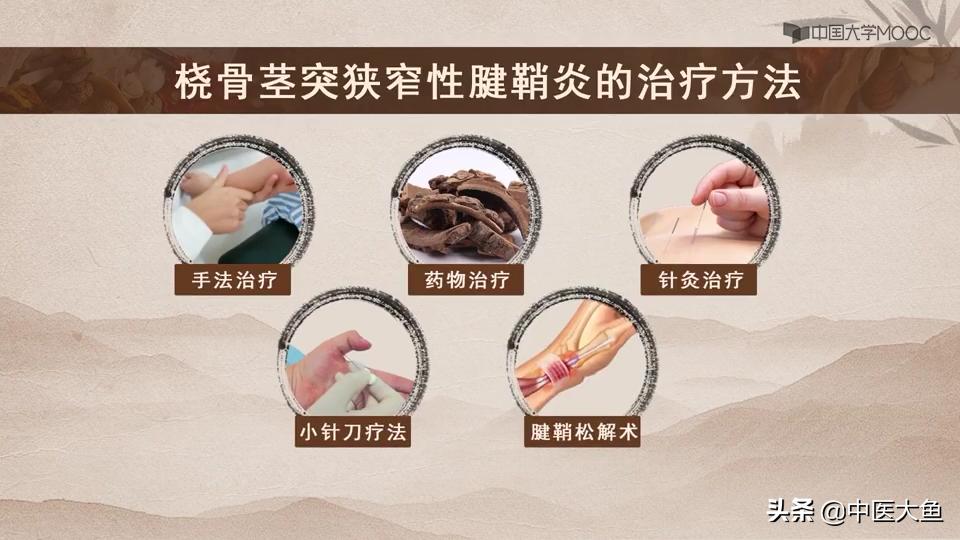 桡骨茎突狭窄性腱鞘炎怎么治疗,桡骨茎突狭窄性腱鞘炎治疗方法